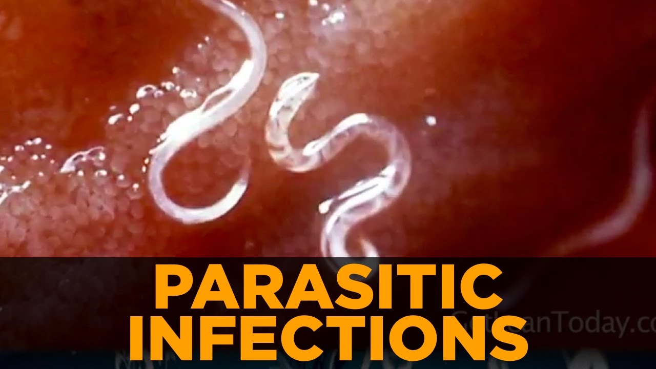 human parasitic infections